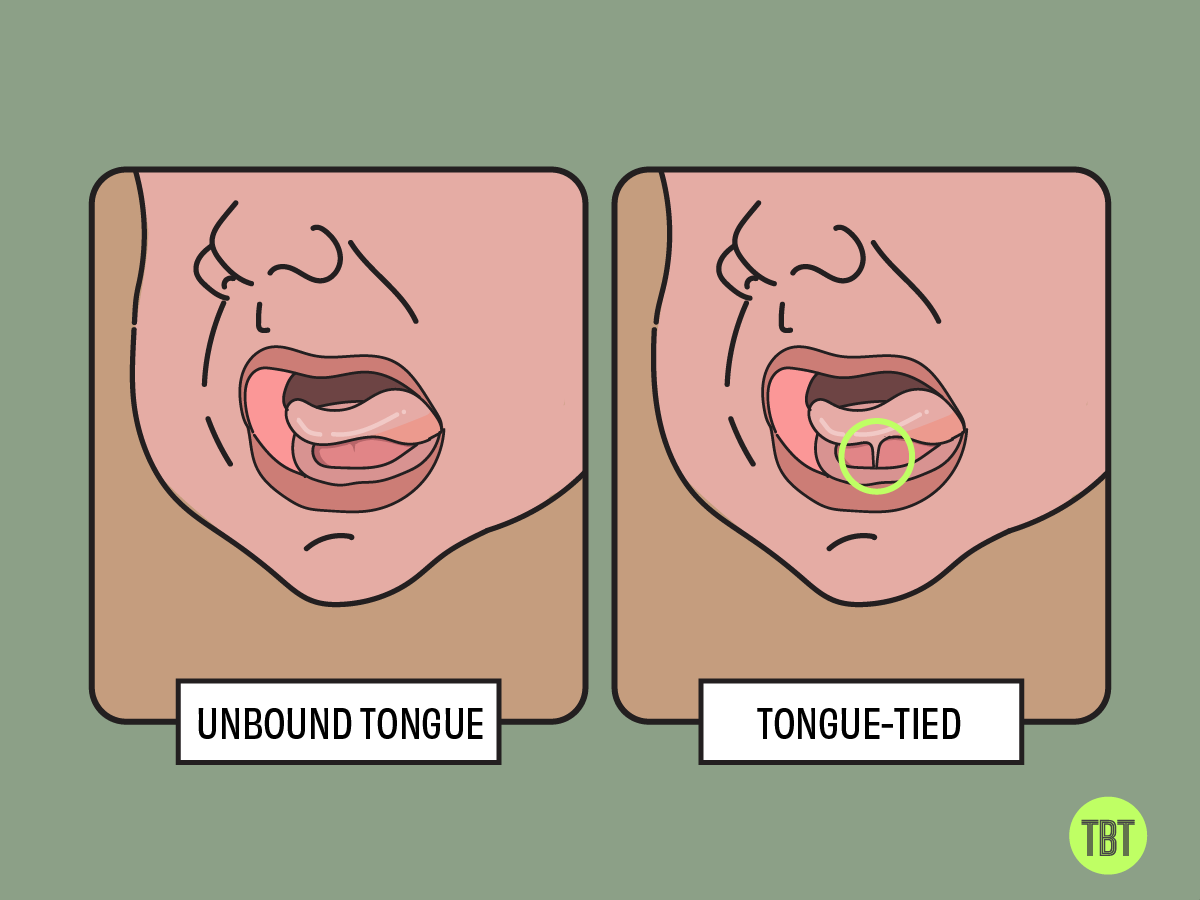 Tongueties in newborns and how to look out for it The Whole Truth